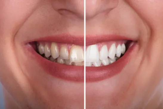 Avant et après un blanchiment dentaire, sourire 1