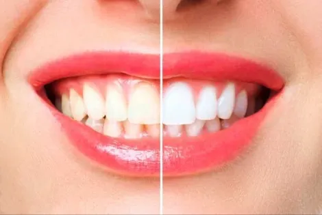 Avant et après un blanchiment dentaire, sourire 2