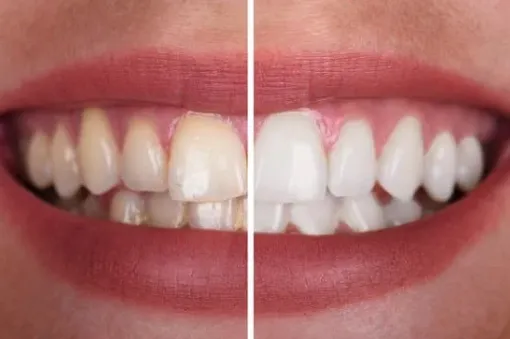 Avant et après un blanchiment dentaire, sourire 3